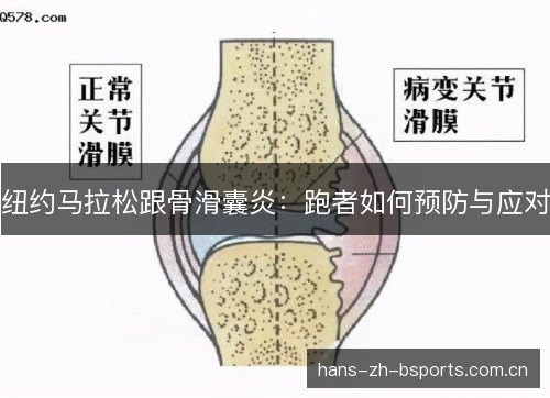 纽约马拉松跟骨滑囊炎：跑者如何预防与应对